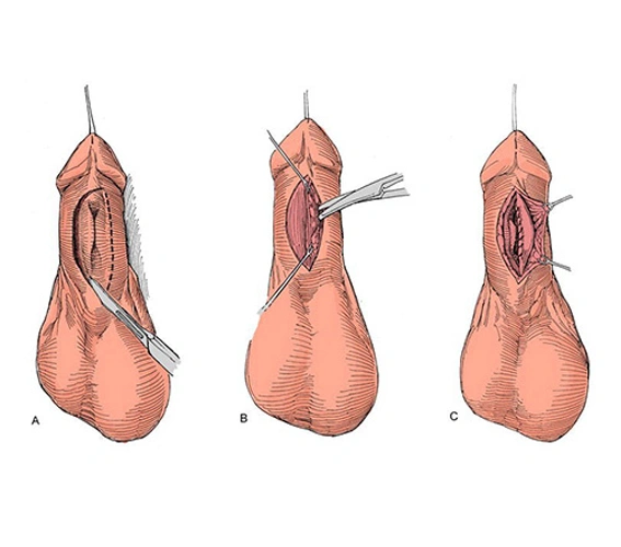 Ureteroplasty Procedure Steps