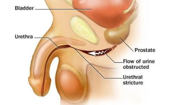 Ureteral Stricture