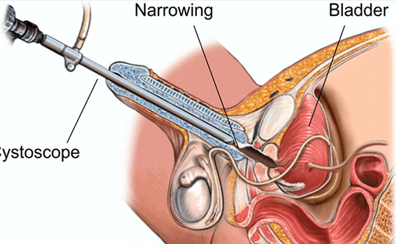 OIU VIU Surgery for Urethral Stricture