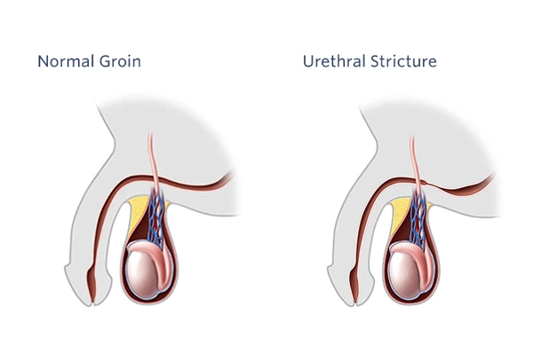What is a Urethral Stricture