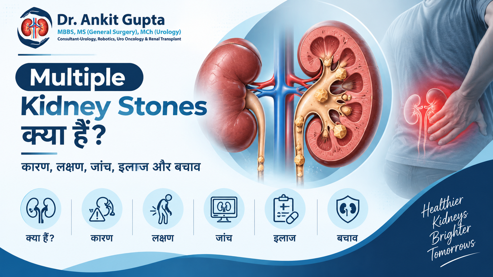 Multiple Kidney Stones क्या हैं